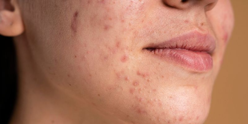 oily acne-prone skin