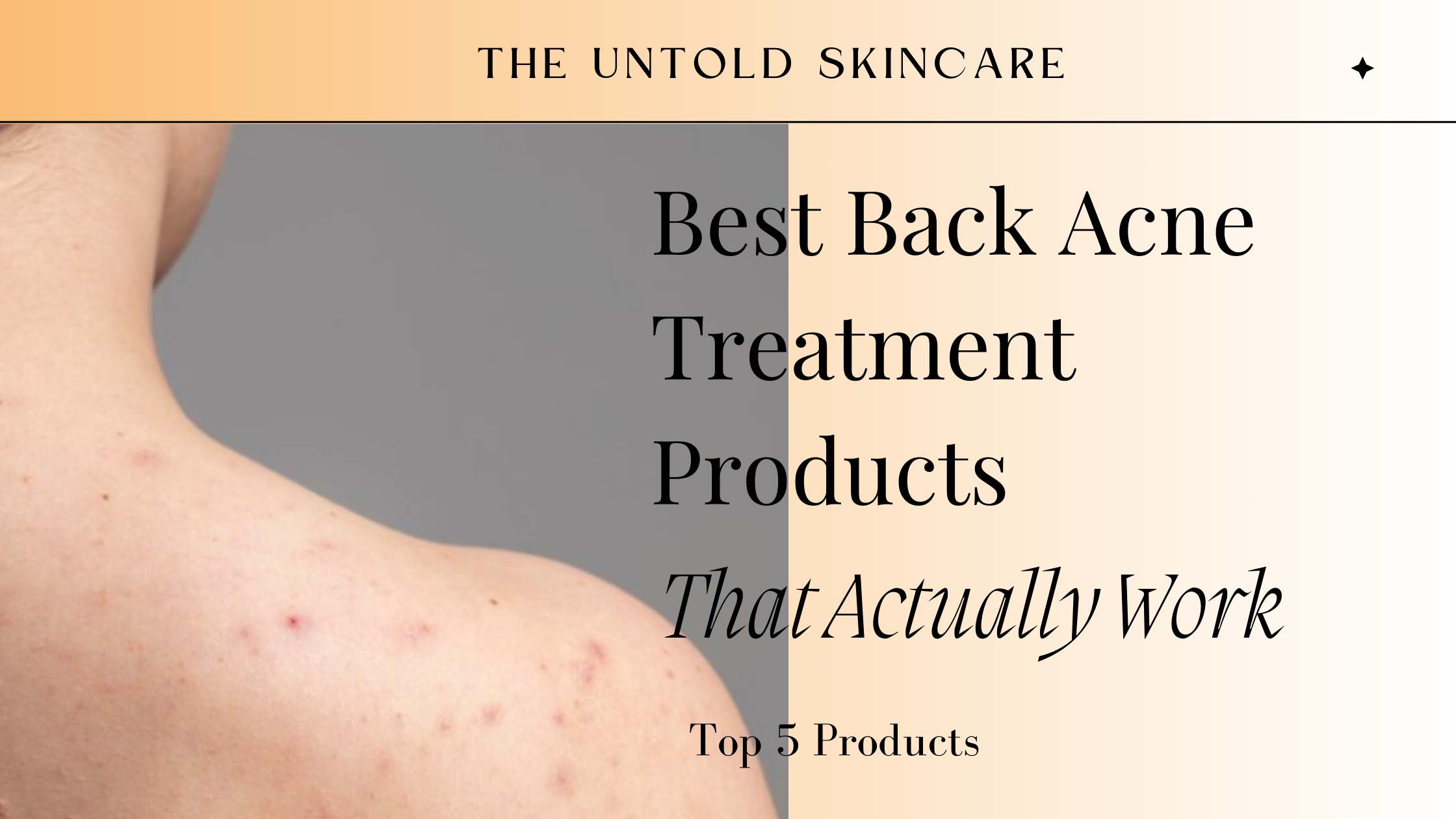 Best Back Acne Treatment Products That Actually Work: Top 5 Products