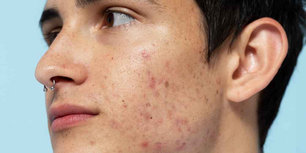 a man with a side look having a lot of acne scars on his face