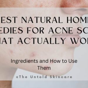 Best Natural Home Remedies for Acne Scars That Actually Work