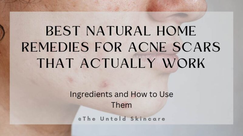 Best Natural Home Remedies for Acne Scars That Actually Work