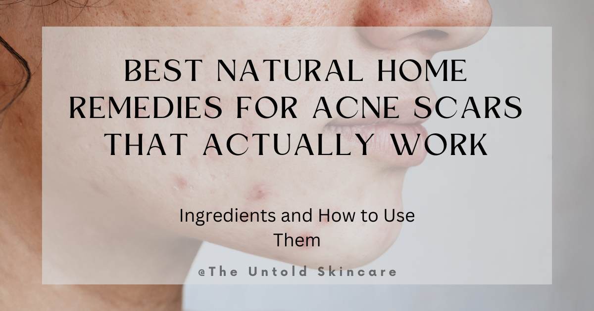 Best Natural Home Remedies for Acne Scars That Actually Work